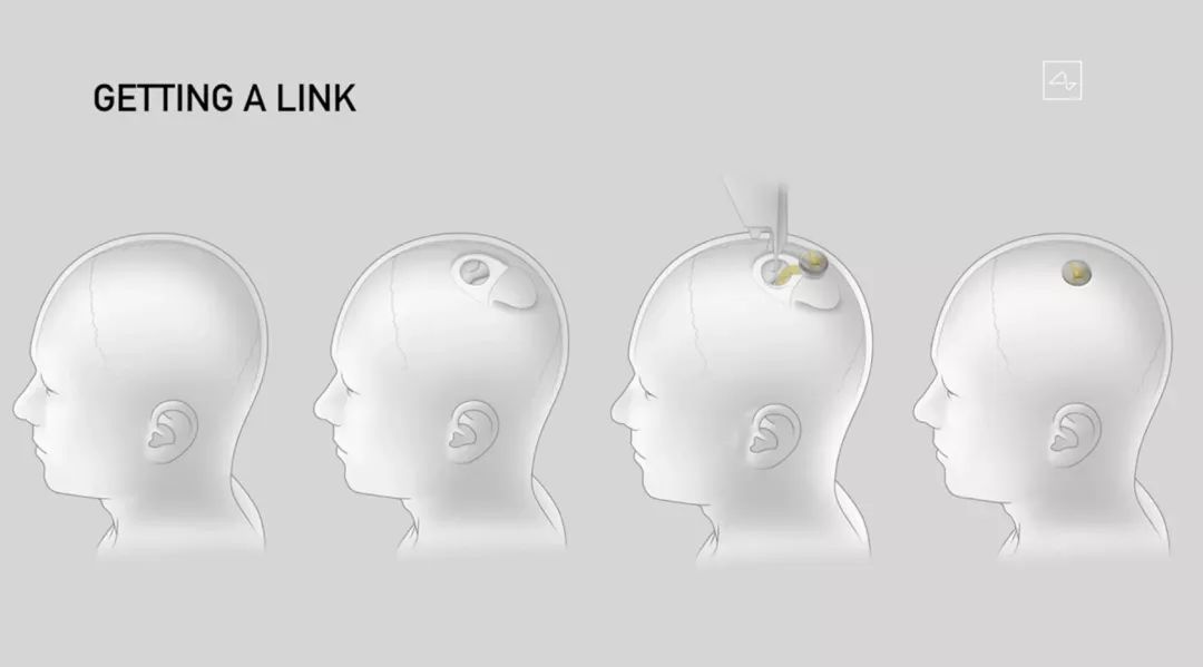 馬斯克發(fā)布腦機(jī)接口重大突破！藍(lán)牙連接，一小時植入，終極目標(biāo)是實(shí)現(xiàn)數(shù)字永生！